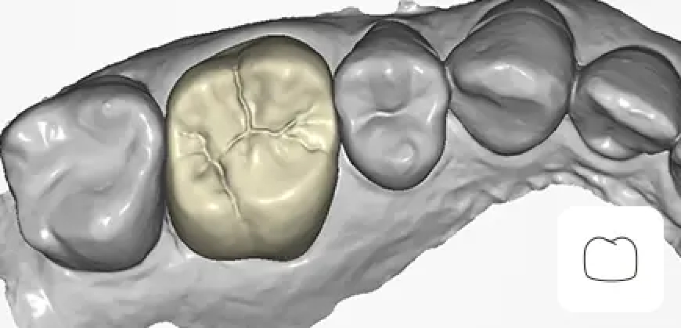 Full Contour Crown Design